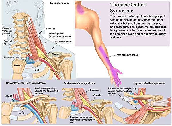 Image courtesy of http://mybwdoc.com/wp-content/uploads/2011/11/thoracic-outlet-syndrome.jpg