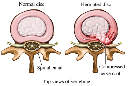Image courtsey of http://physioworks.com.au/images/Injuries-Conditions/Bulging-Disc.jpg