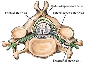 Image courtesy of http://spinalstenosis.org/blog/wp-content/uploads/2011/12/foraminal-cervical-stenosis-diagram.jpg