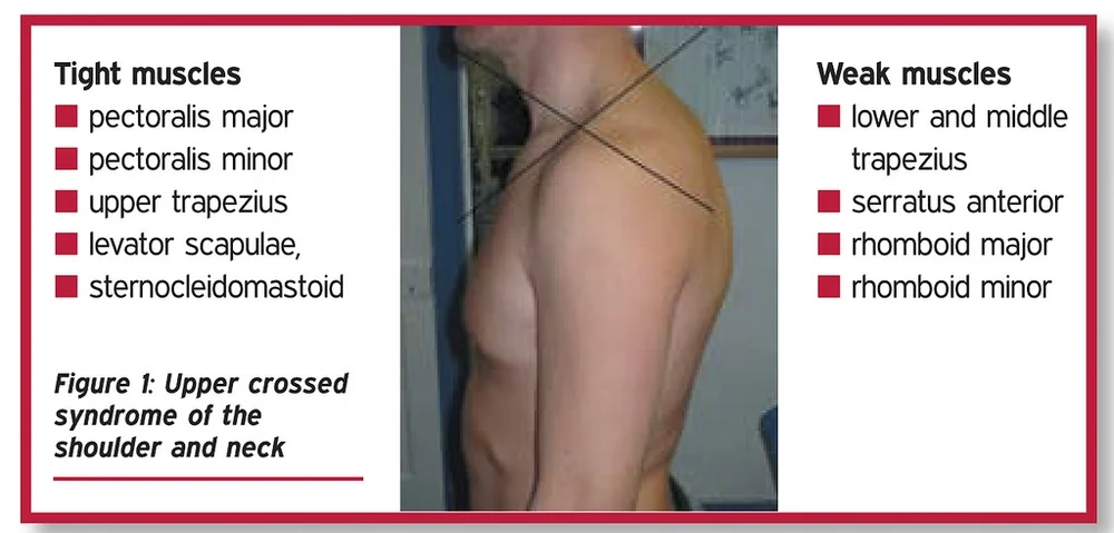 Upper Crossed Syndrome Whole Body Health Physical Therapy Portland Oregon