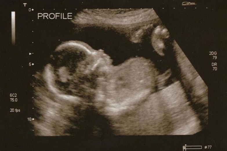 Load Up on Folic Acid Foods!