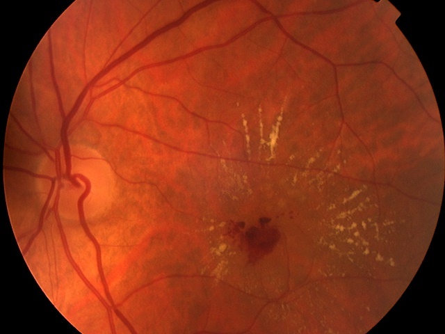 The macula affected by leaking blood vessels in Diabetes