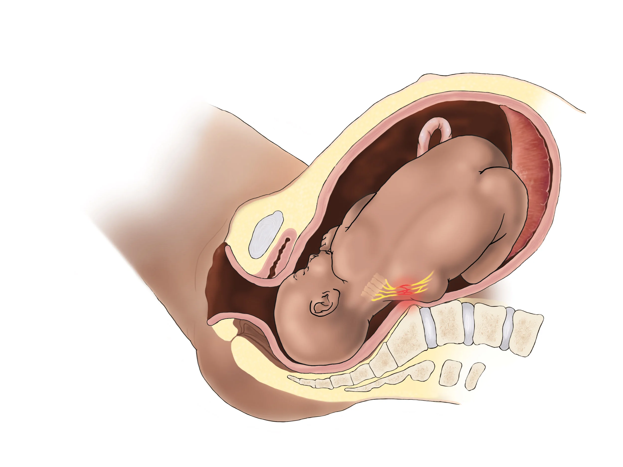 PosteriorShoulderDystocia_Exhibit4.jpg