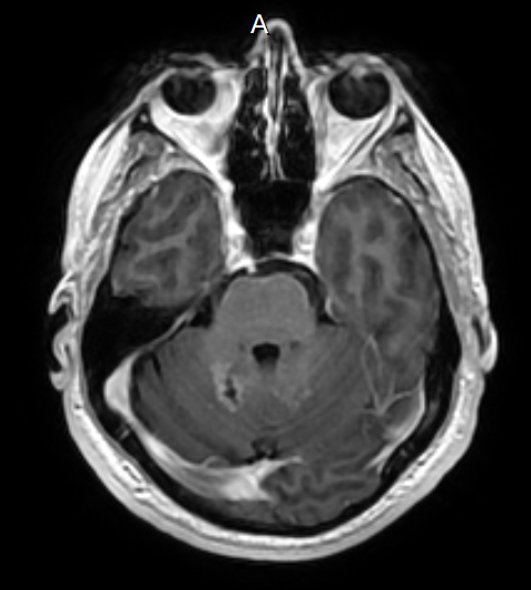 2011 Post Op Brain MRI. The start of my new life.