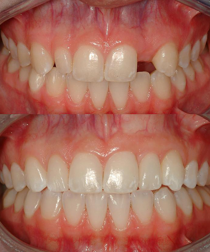 e.Max #'s 7 and 10, Zirconia Implant Abutment #10