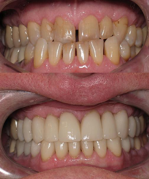 e.Max #'s 4-13, 20-28, Layered Zirconia #'s 29 and 30