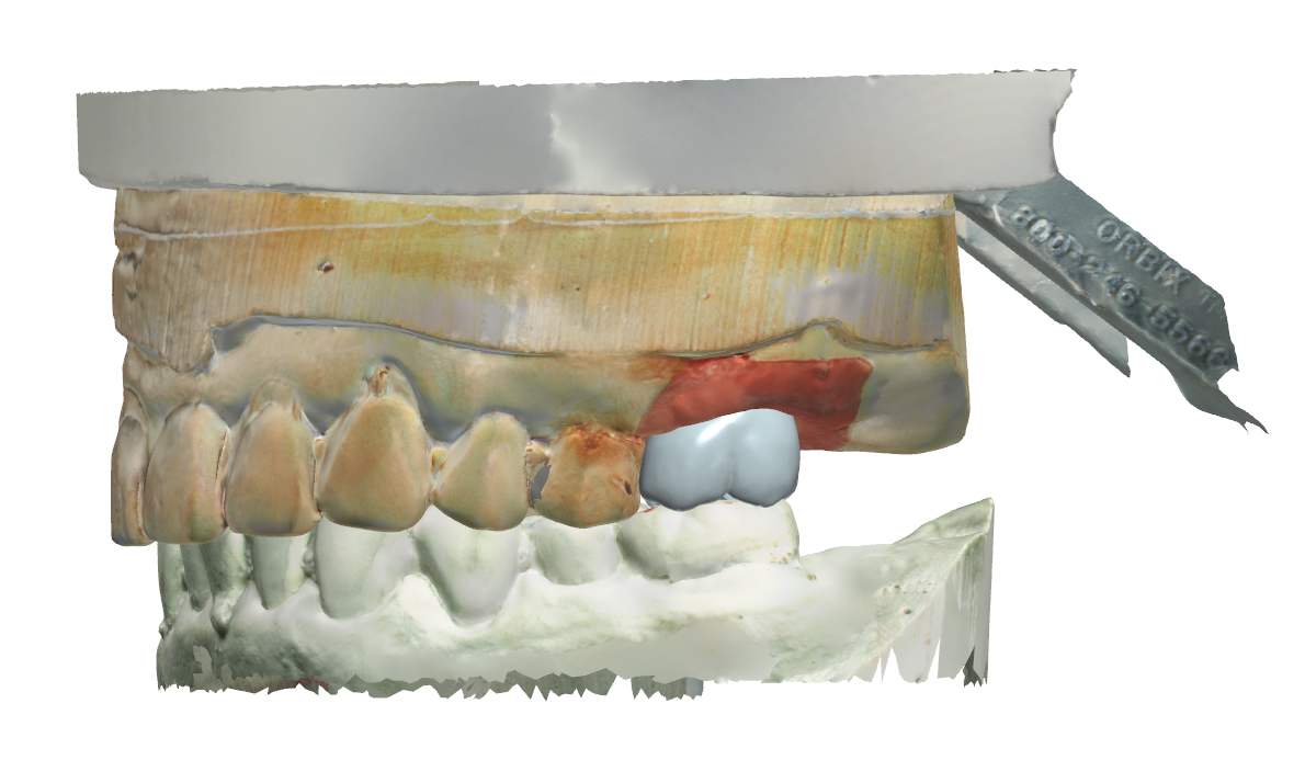 Digital Design of Screw Retained Crown