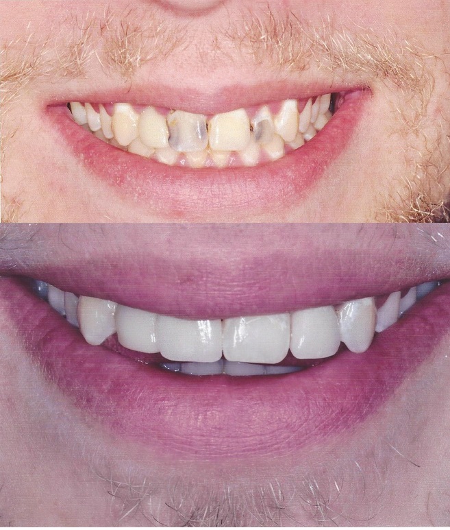 Porcelain to Zirconia #8 & #10 (#7 was a previous crown, and #9 is a natural tooth)