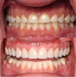 #6-11 Non Layered E.Max by Dr. Vislisel (8/2016) 