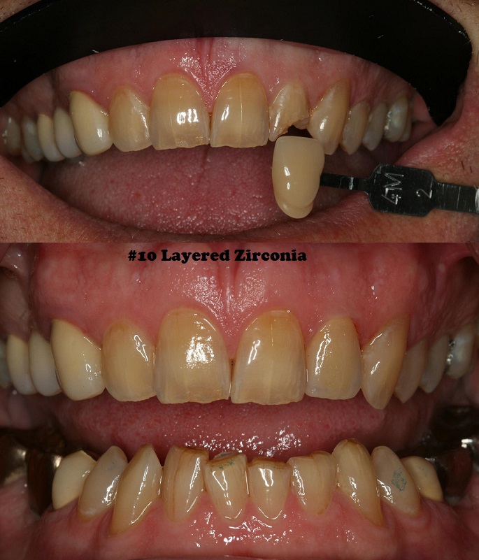 #10 Layered Zirconia