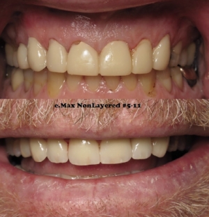 e.Max Nonlayered #5-11. January 2018