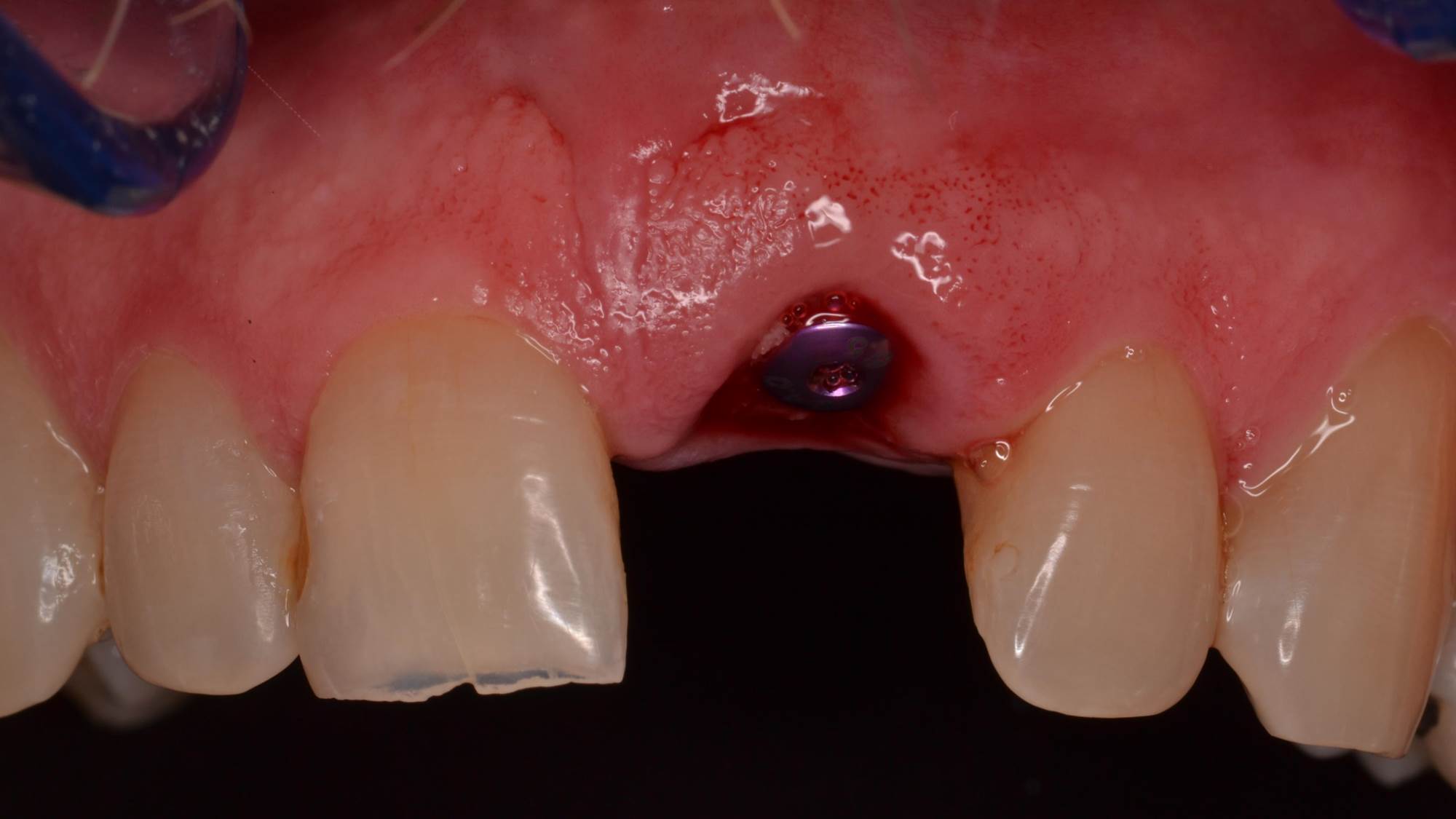 Figure 5c; Immediate implant placement at time of extraction