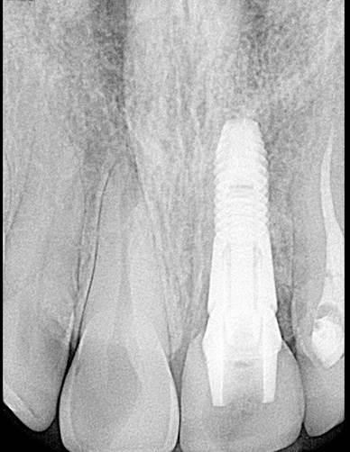 Figure 4b; The fixture platform is placed at the level of the adjacent gingival zenith, when it should be 3 mm apical to this landmark