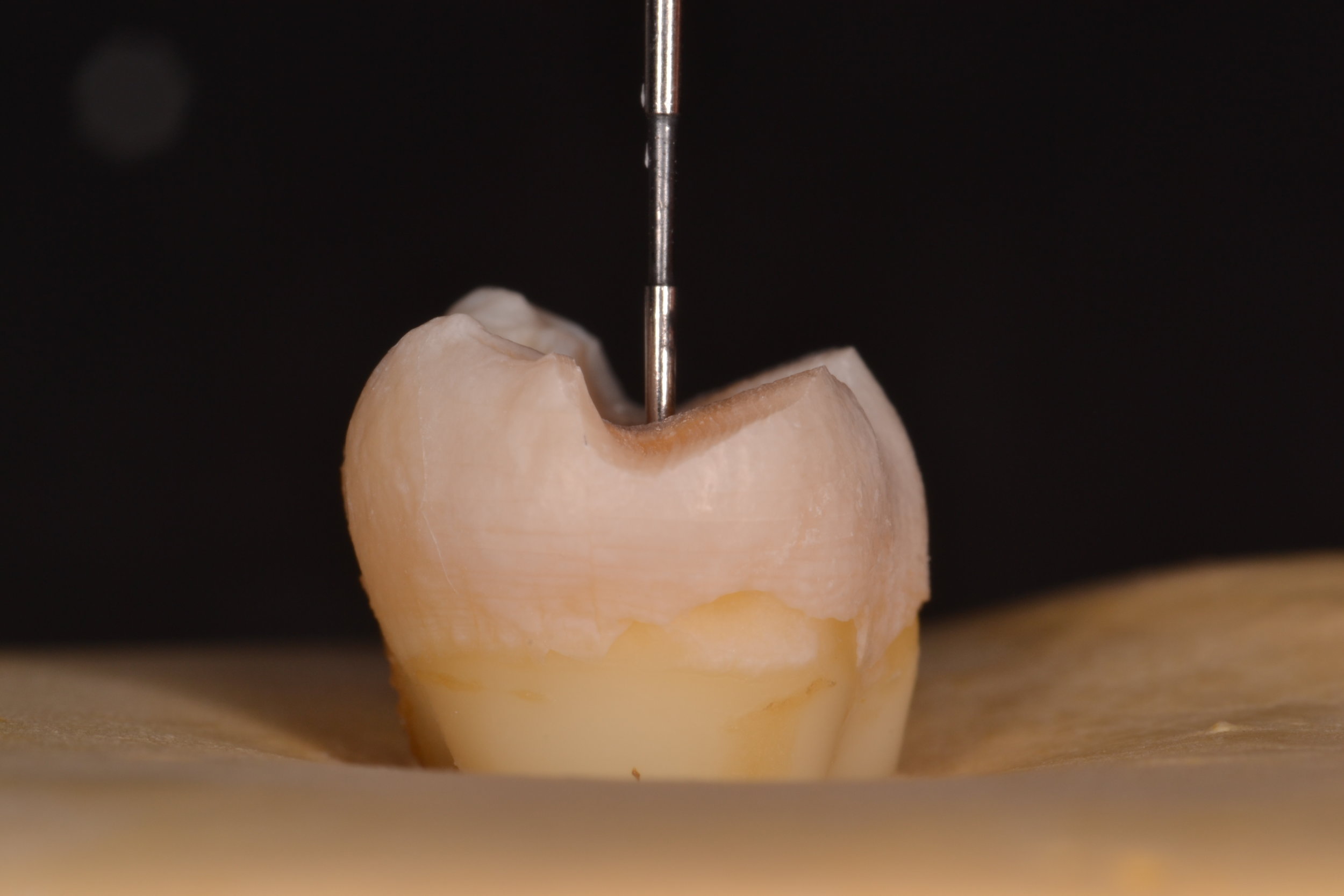 Figure 1a; 2 mm occlusal table reduction, buccal half of a mandibular second molar from a mesial view