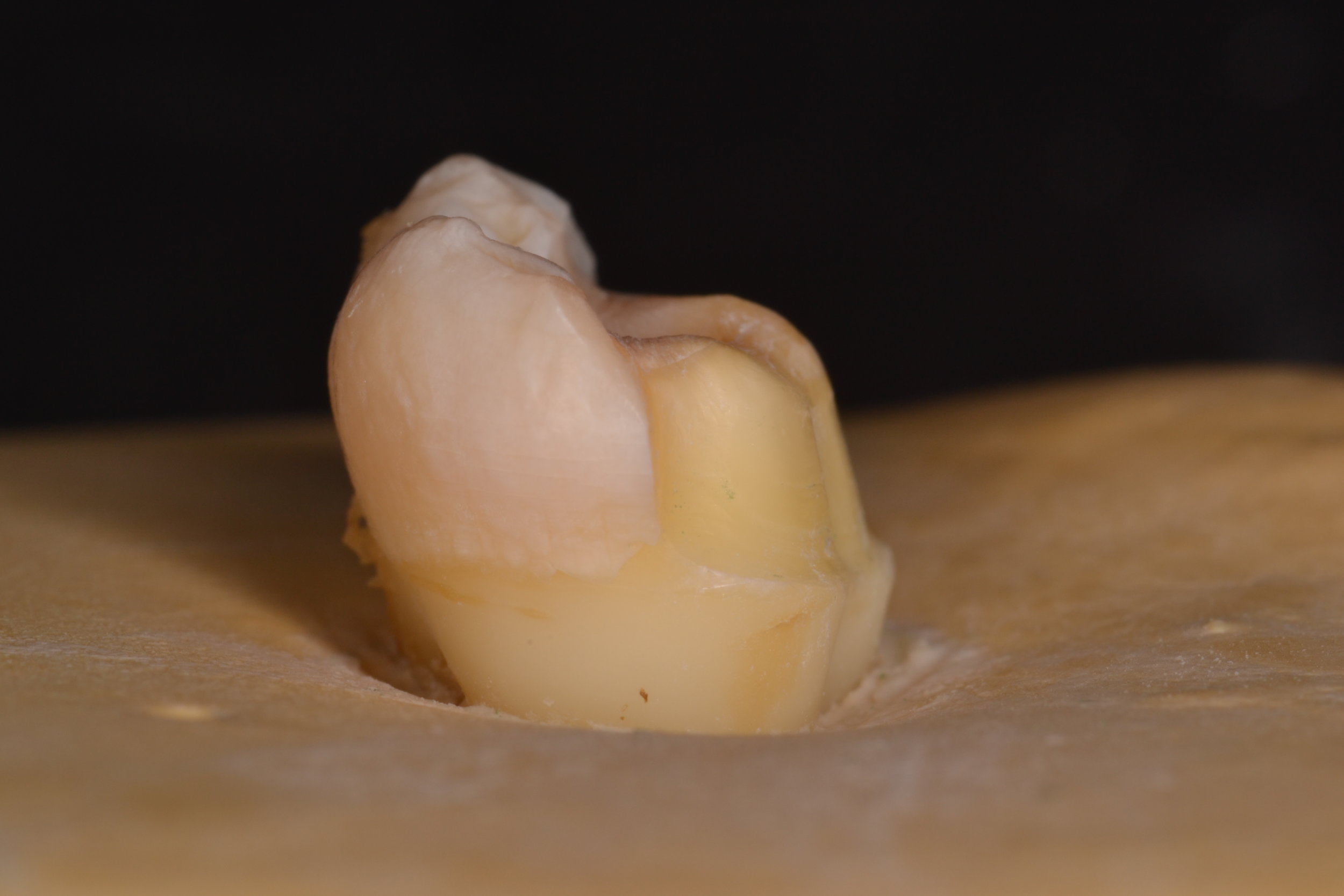 Figure 2; The buccal half is prepared to the finish line with a function cusp bevel that is smooth and will not concentrate forces capable of fracturing the all ceramic restoration.