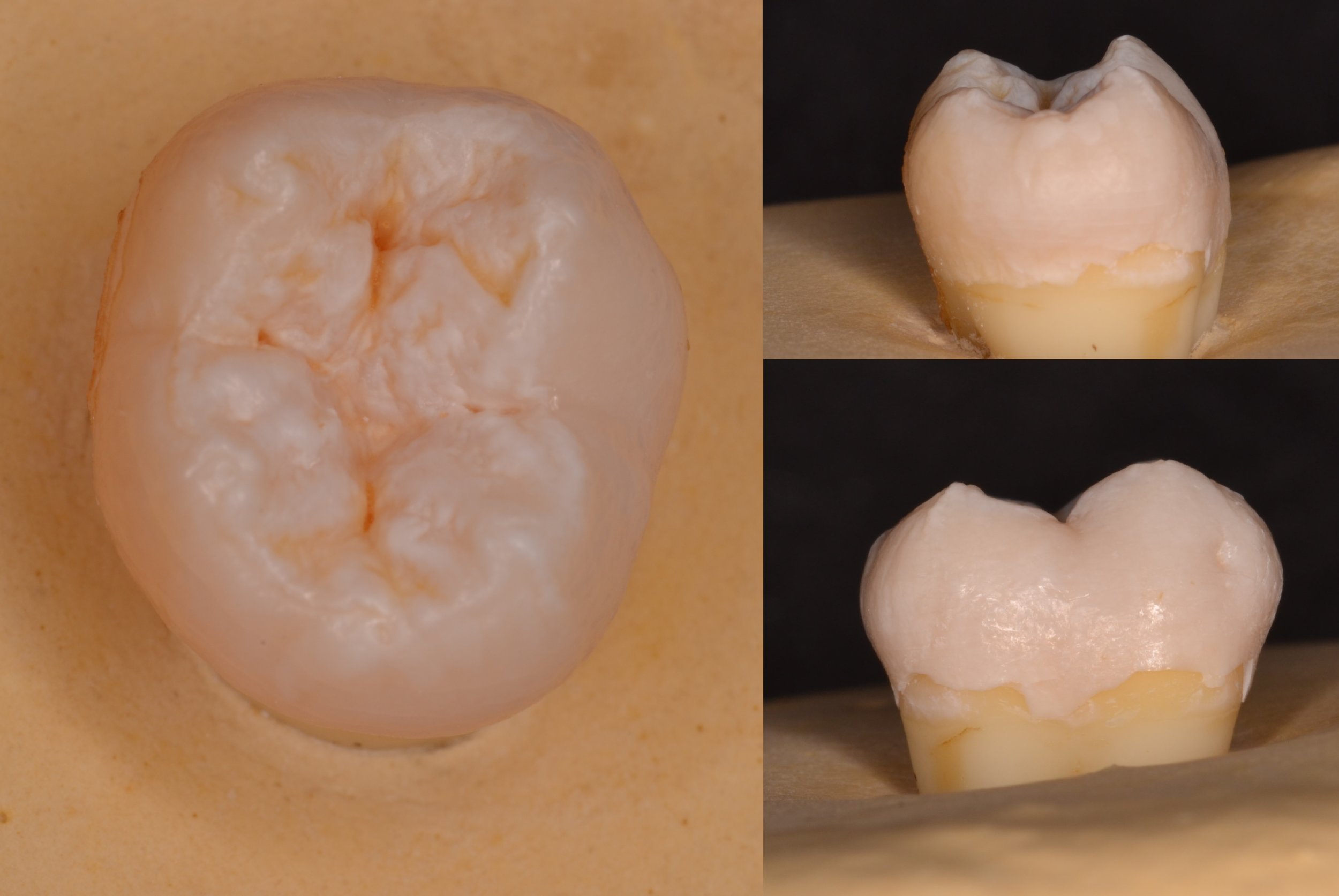 FIgure 0; pre-operative view of a mandibular second molar.