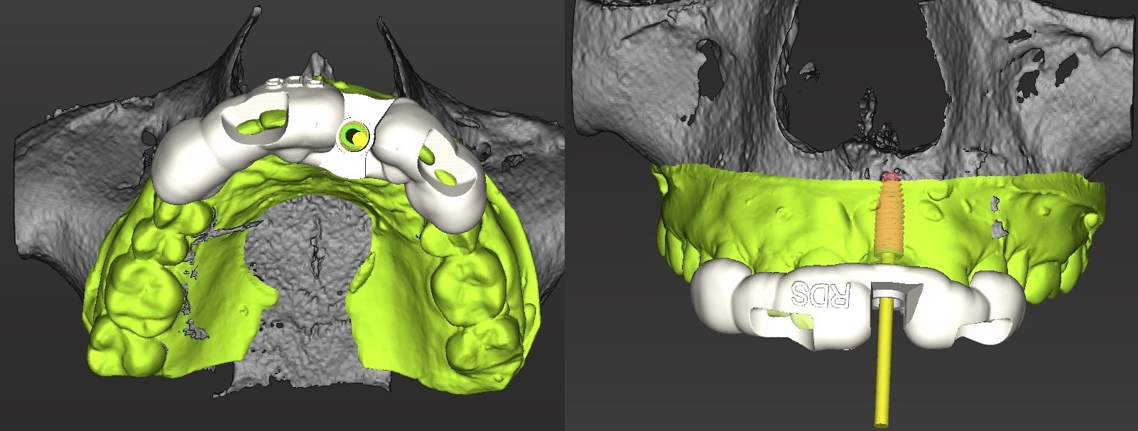 Figure 2c; Surgical drilling guide plan in CAD, ready to be 3D printed.