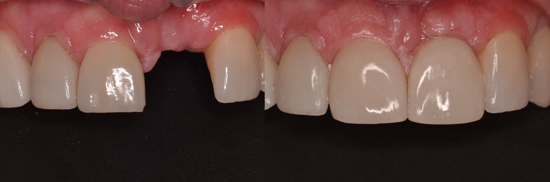 Figure 4 c; Before and after photo of restored dental implant to replace tooth #9 (from Figure 2 plan). Implant surgery performed by Dr. Andrew J. Carmosino, DDS, MS
