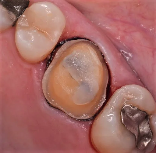 Figure 6; Clinical photo of monolithic eMax crown preparation of a maxillary first molar.
