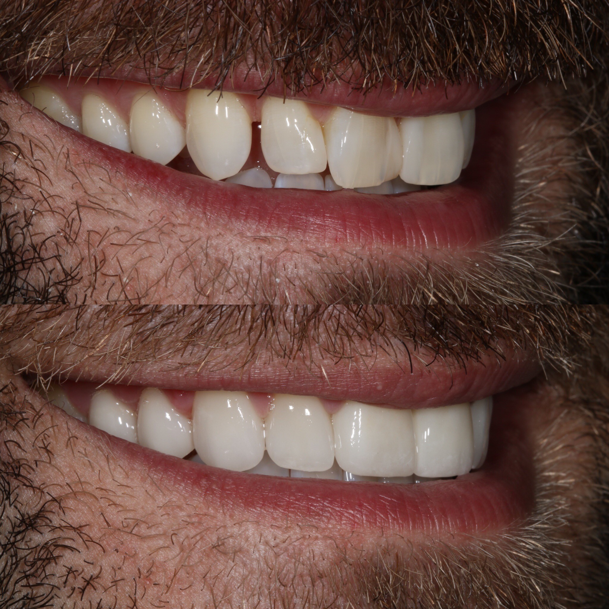 Figure 3; Before and after closing a diastema with porcelain.