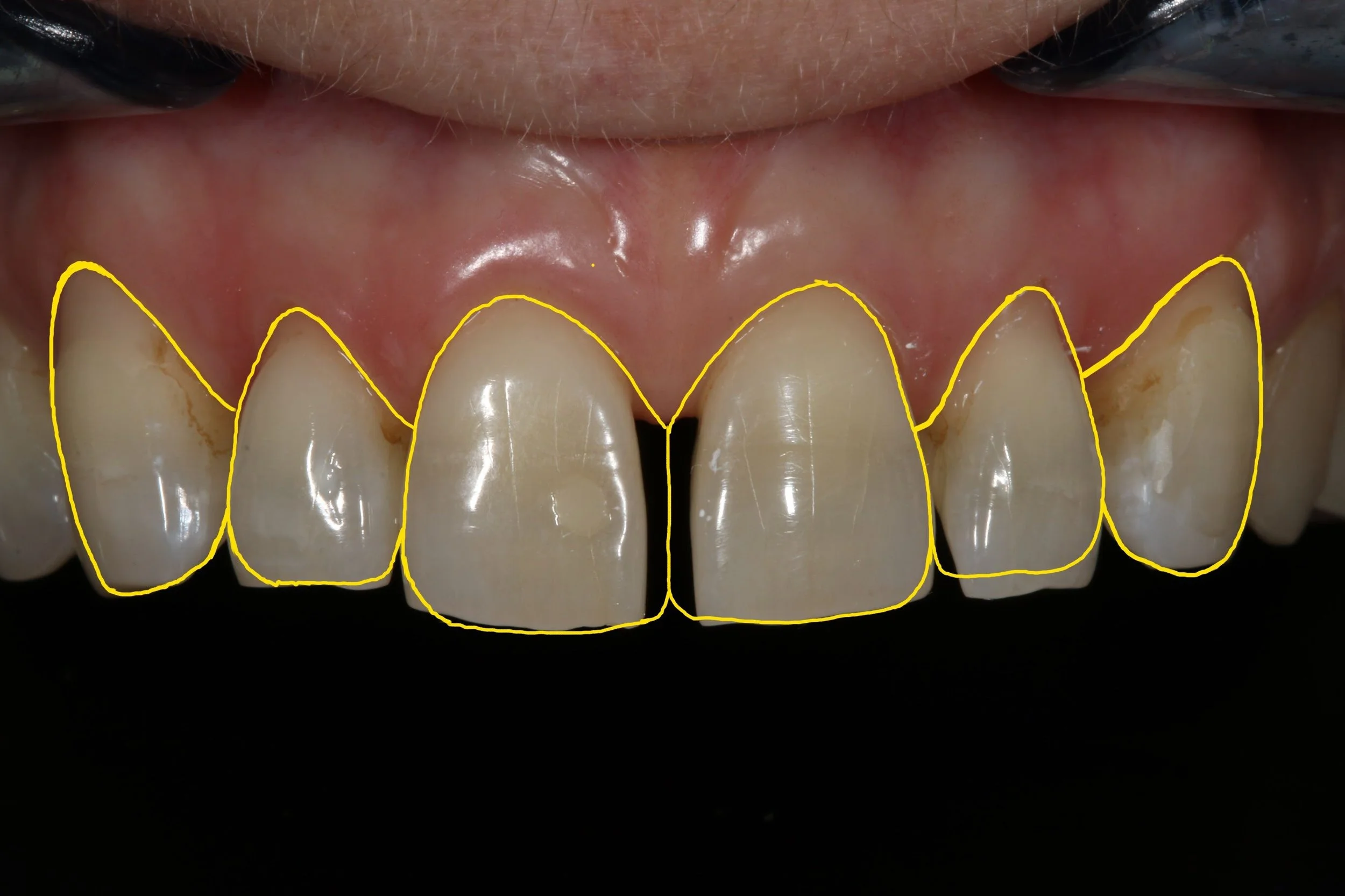 Figure 4; The desired outcome after indirect restorations.