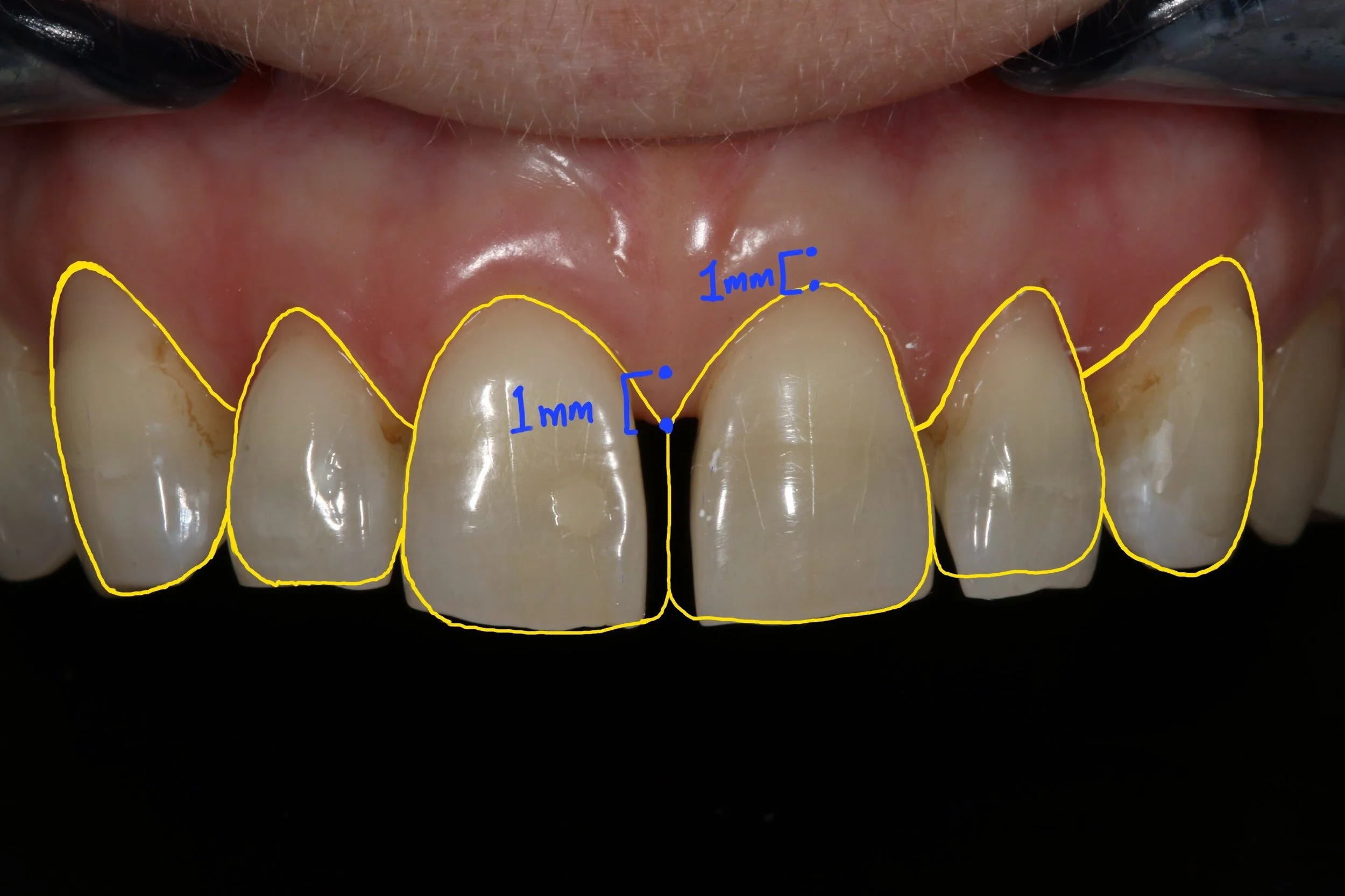 Figure 6; Distance from gingival margin to preparation margin