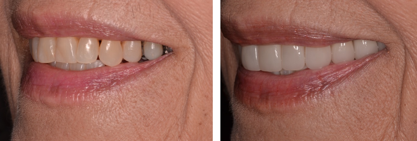 Figure 7b; Black triangle closure using the proposed protocol and laboratory instruction for predictable soft tissue results (3:1 magnification lateral view)(Case and photos by Dr. Ryan Yakowicz)