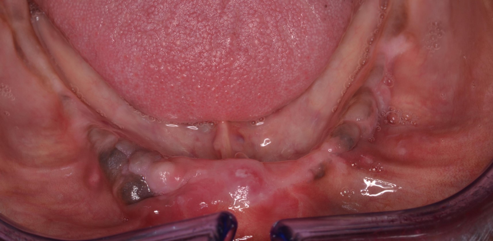 Figure 1a; The edentulous mandible.