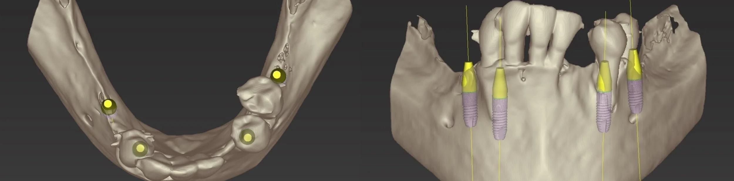 Figure 2; Digitally assisted planning of the implant position.