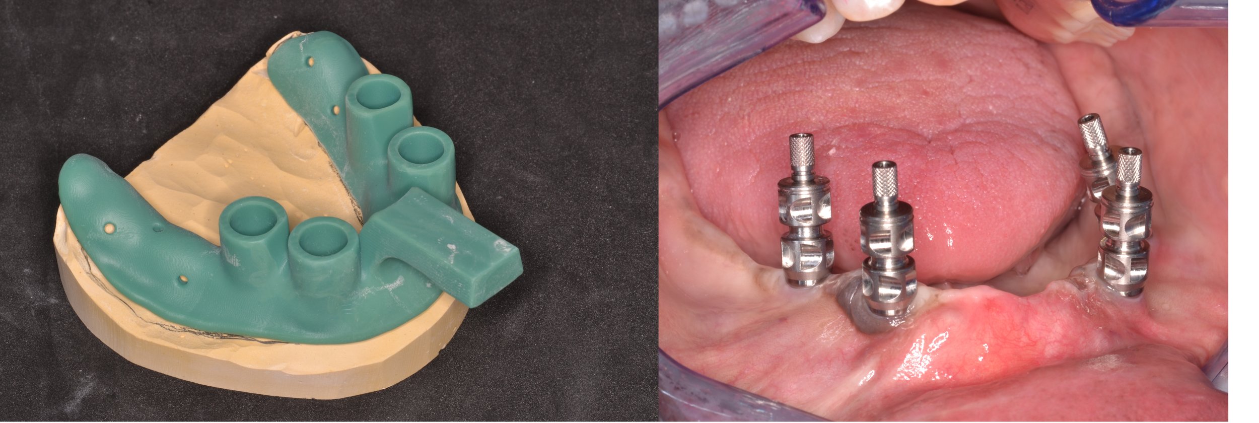 Figure 5; Custom tray, and Multi-Base Abutment impression posts in place.