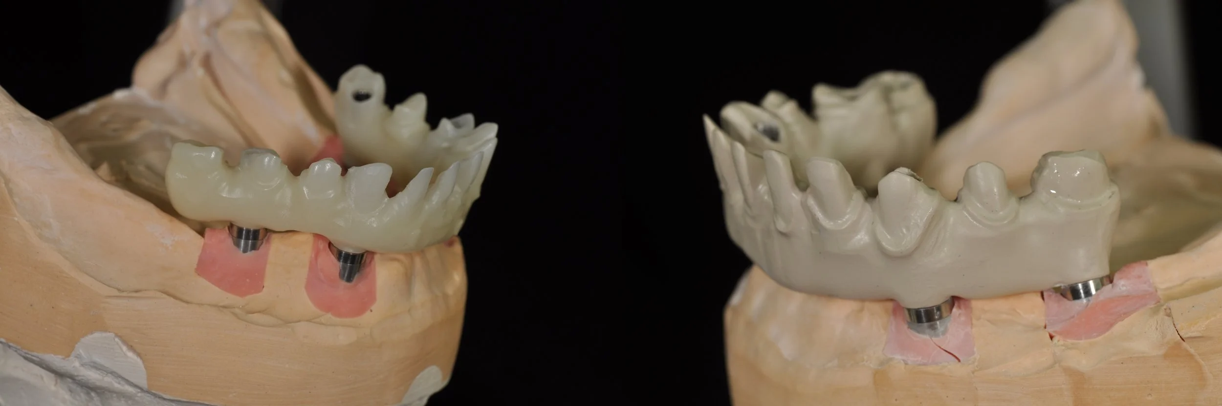 Figure 9a and 9b; Digital design of the prosthesis and the PMMA trial framework on the left and the definitive PEEK framework on the right.