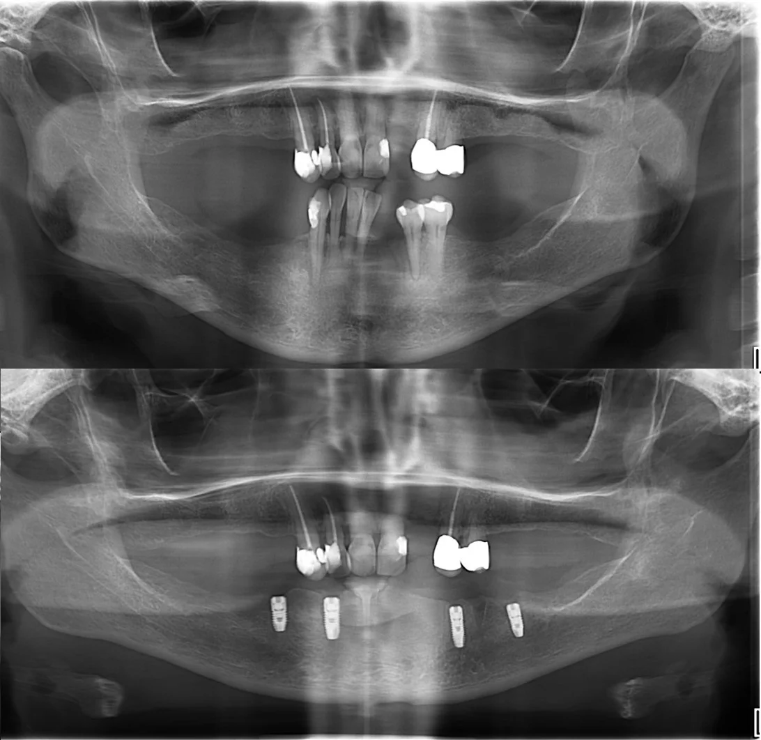 Figure 3b; Pre-operative and post-operative panoramic radiographs.