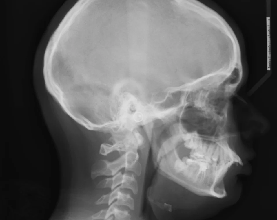 Figure 1b; A cephalometric radiograph of the patient