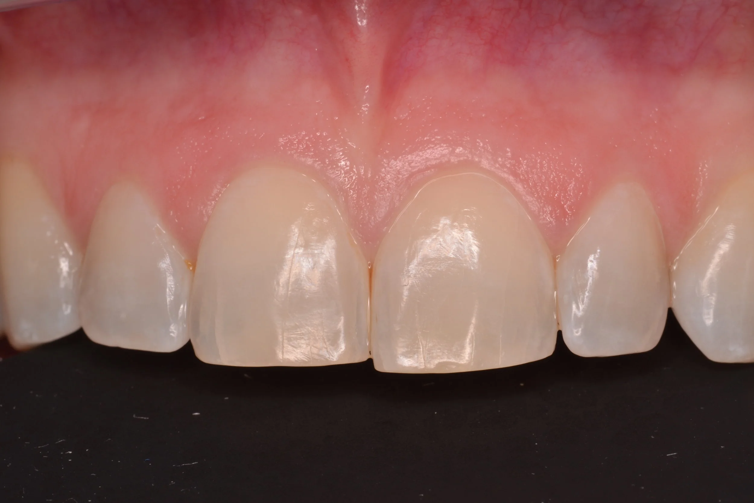 Start to Finish Veneers: Part 1, Treatment Planning