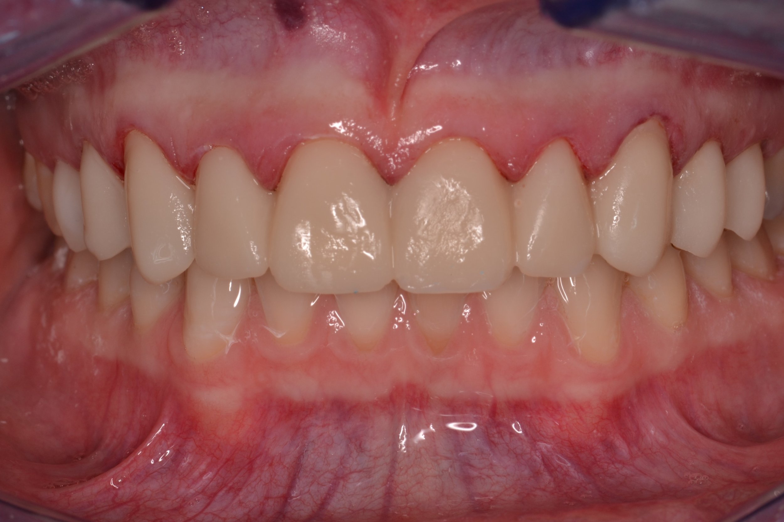 Figure 9m, The finalized provisional restorations on the preparation day.