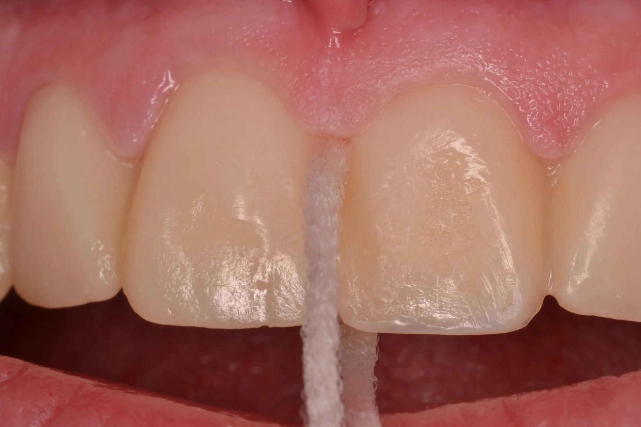 Figure 10; passing super-floss through healthy gingival embrasures post-operatively.