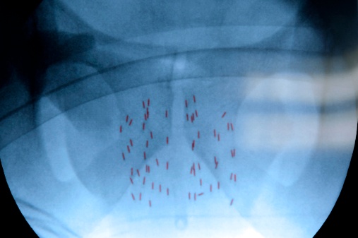 X-ray showing the placement of radioactive seeds within the prostate