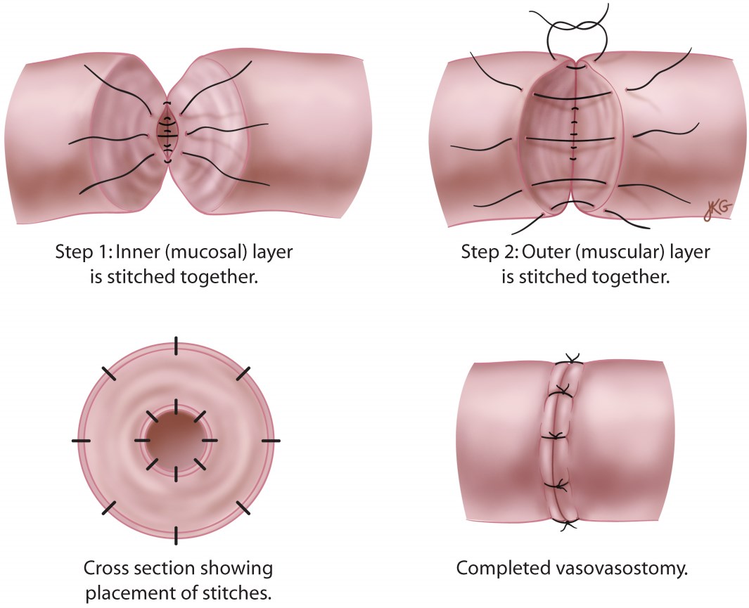 Vasectomy reversal (vasovasostomy) — Urology Associates