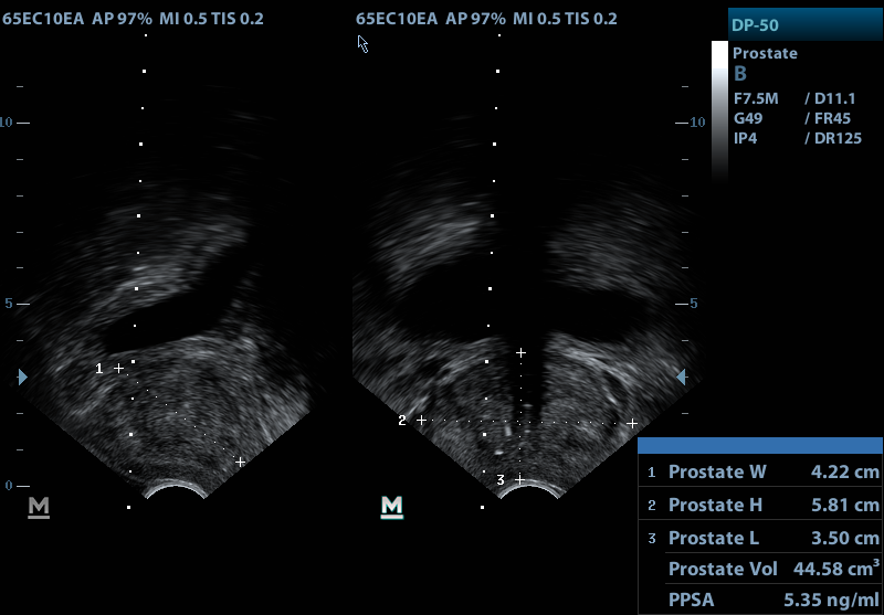 trus prostate