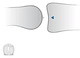 A single point on concave surface contact multiple points on convex surfaces