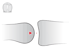 A single point on convex surface contacts multiple points on concave virtual surface.