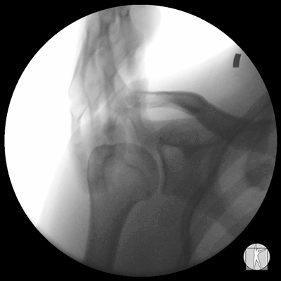 (Grade 0) Shoulder Abduction AJM inferior shift Significant joint displacement observed (Mobilize more articulating joint surface, stretch more active and passive restraints)