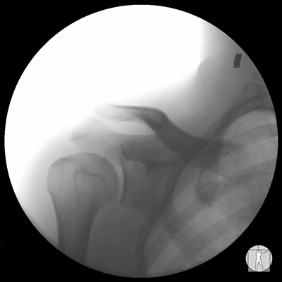 Normal shoulder abduction