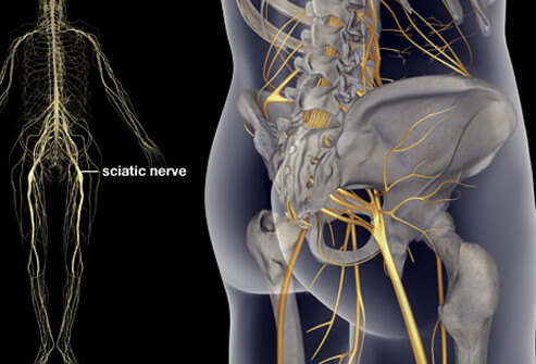 sciatica-s1-illustration-of-sciatica.jpg