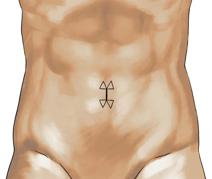 umbilicoplasty1_small1.jpg