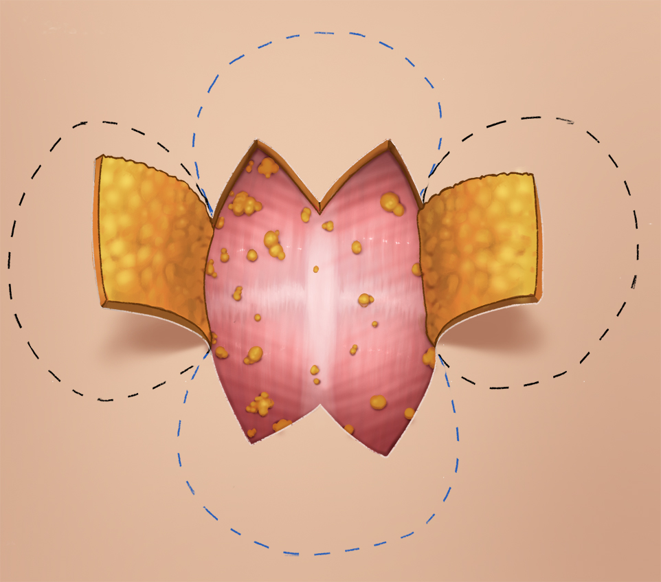 umbilicoplasty2_4.jpg