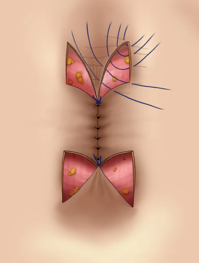 umbilicoplasty6_new1.jpg