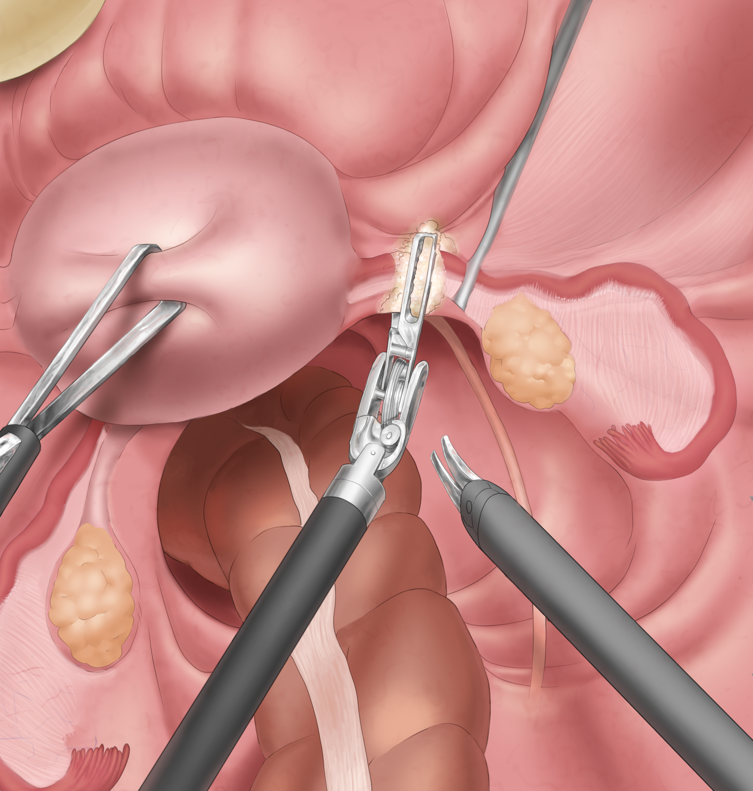hysterectomy.png