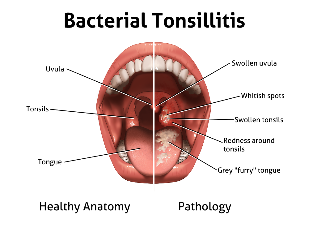 tonsillitis small.png