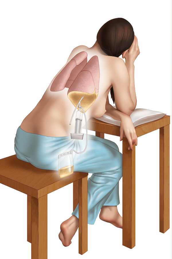 thoracentesis small.png